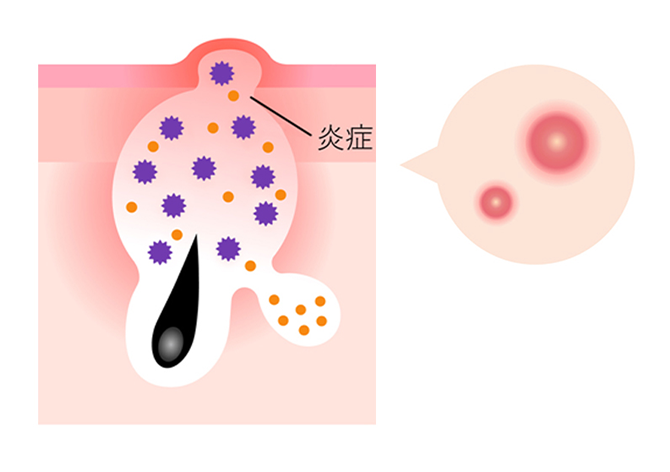 赤ニキビ（炎症の起こしたニキビ）