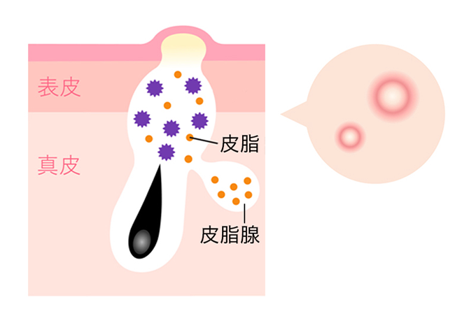 >白ニキビ（ニキビの前段階）