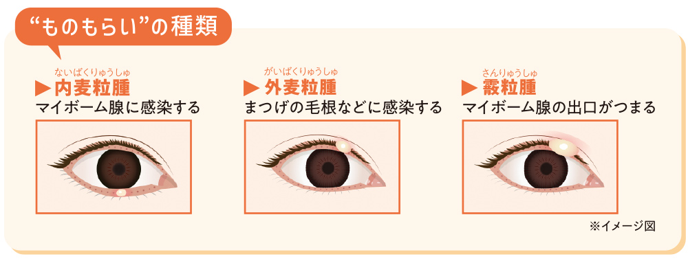 ものもらいの種類
