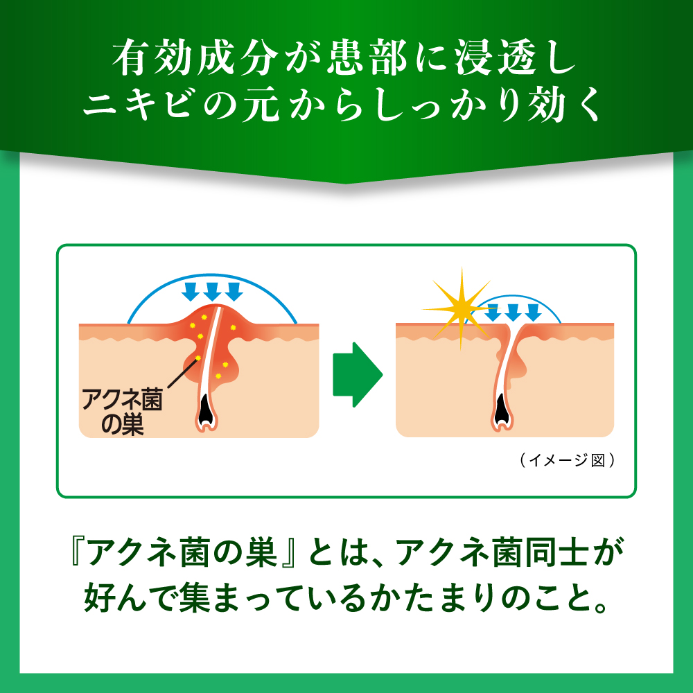 【第2類医薬品】メンソレータムアクネス25メディカルミストb